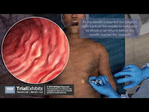 Percutaneous Endoscopic Gastrostomy (PEG Tube) Insertion