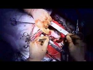 Repair of Complete AV canal defect by double patch technique