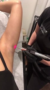 Laser Hair Removal Q&A Q: does laser hair removal work on blonde hair? A: no, lasers target pigment. It can treat hair in all areas with dark pigmentation at the root Q: how many treatments will I need? A: it depends. Most areas responded great and required 8 to 12 treatments. You normally see about an 80% reduction in growth with six treatments. Q: do any medications interact with laser? A: yes, you will have to be off antibiotics two weeks prior to any laser appointment. And we cannot treat if