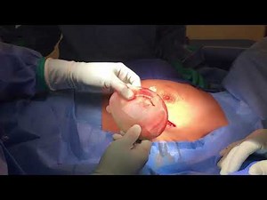 Breast Reconstruction - Second Stage - Tissue Expander to Silicone Implant