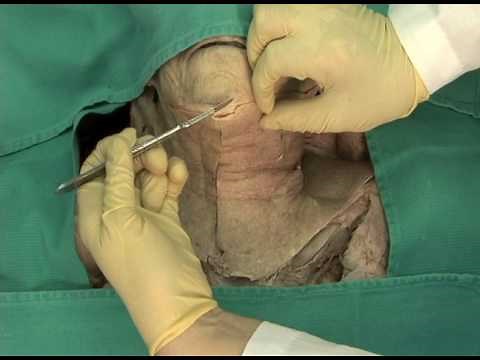 1.2 Step 1. Removal of skin and exposure of platysma muscle