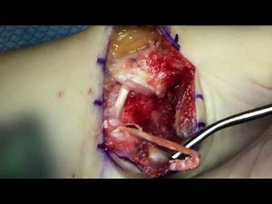 Basal Joint Stabilization