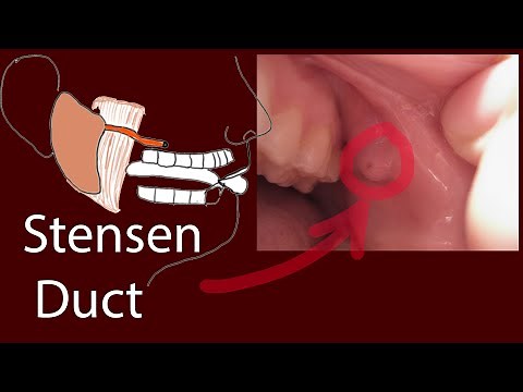 Bump inside mouth - Parotid duct Diseases. Stensen duct; Sialolithiasis