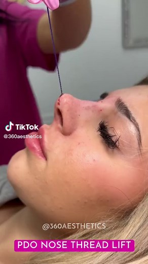 PDO NOSE THREAD LIFT 🪡 👌🏼 #nosethreads #nosethreadlift #pdonose #pdonosethreads #pdonosethreadlift #pdonosejob #nonsurgicalnosejob #pdothreadsuk #pdothreadslondon #pdothreadsbedfordshire #fypシ #fypage #fypシ゚viral