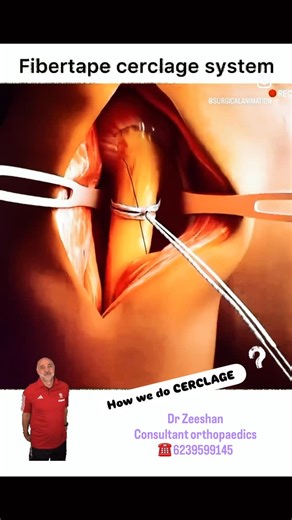 Dr Zeeshan | 🦴 ENCERCLAGE (CERCLAGE WIRING) – FACTS EVERY ORTHOPAEDIC SHOULD KNOW 🦴 🔩 What is Encerclage? Encerclage is a circumferential wire or cable... | Instagram
