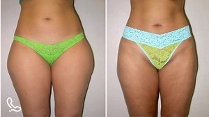 Thigh liposuction can effectively remove excess fat, giving the legs and hips a more proportioned contour. #liposuction #lateralthinking #liposuctionsurgery #liposuccion #lipoescultura | Manhattan Surgical Care