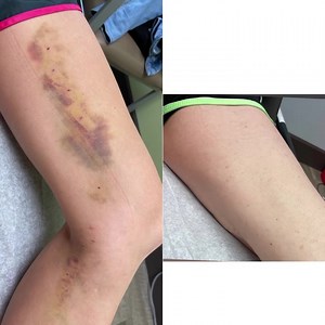 Miicrophlebectomy for varicose veins. Large veins like this are...