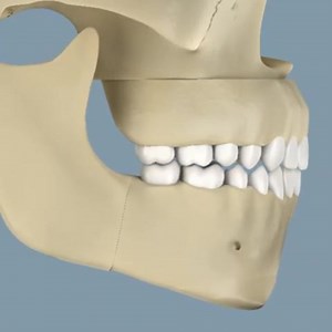 Orthognathic Surgery. @Bites.Braces #Dentistry #LearningTips #BitesnBraces | Dr. Syed Naveed Manzoor