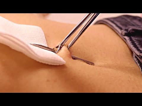 Belly Button (Navel) piercing Procedure, needle poke | Navel Play