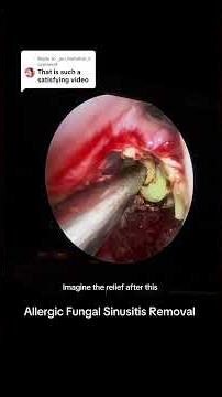 Allergic Fungal Sinusitis Removal 👀