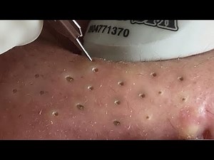 Huong Da Nang Acne Treatment #367