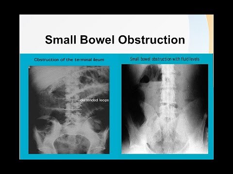 Small bowel obstruction
