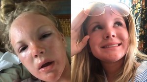 2.4K views · 32 reactions | A viral TikTok video showed the painful symptoms of sun poisoning, even in cloudy weather. We spoke to an expert who explained how you can protect yourself. Watch more video: https://www.theweathernetwork.com/en/video | The Weather Network | Facebook
