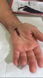 This is my patient, Tim, who required revision carpal tunnel surgery. Revision carpal tunnel is a lot more involved than a primary procedure. I wanted to show you how Tim is doing one day after his surgery. Take a look! #drcohenhandsurgeon #drglenncohen | Dr. Cohen Hand Surgeon