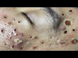 Loan Nguyen Acne Treatment 7yy