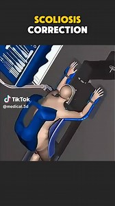 Scoliosis Correction Surgery (3D Animation) #scoliosisawareness #scoliosischeck #scoliosissurgery #scoliosis | Ghost Medical Productions