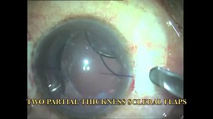 Subluxated 3-Piece IOL - Eyetube
