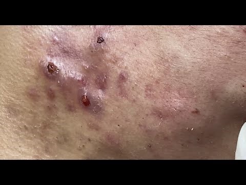Inflammatory acne P1 (Vương) #HoangMySpa61