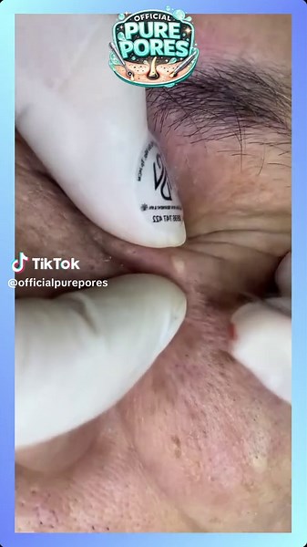 Soothing ASMR Facial Treatments for Blackhead Removal