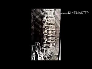 Spondylolysis radiological picture and oblique view Scott dog break in pars interarticularis