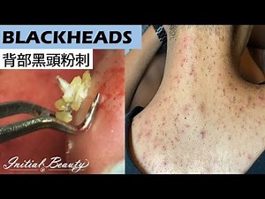 背部黑頭粉刺(blackheads on back) - Taiwan Tainan台南清粉刺最乾淨