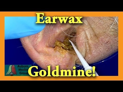 Earwax GOLDMINE | Auburn Medical Group