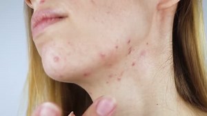 Girl Shows Acne Her Face Acne Neck Demodicosis Chin Redness