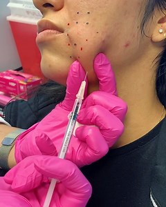 Did you know that Kybella can be used to effectively slim the...