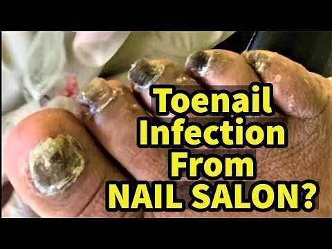 Toenail Infection From Nail Salon?
