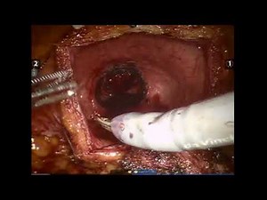 Core Videos (2017): Robotic Assisted Laparoscopic Suprapubic Simple Prostatectomy Step by Step