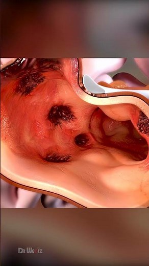 What Is Colonic Diverticulosis