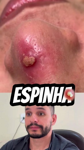 Acne: Causas, Sintomas e Tratamento