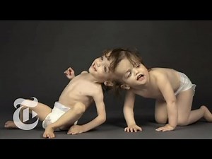 Krista and Tatiana Hogan - Alchetron, the free social encyclopedia