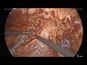 LAPAROSCOPIC TVT MESH REMOVAL WITH BURCH COLPOSUSPENSION
