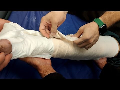 Long leg circular cast application