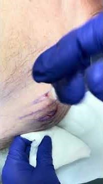 Prolotherapy injection of shoulder using 15% Dextrose