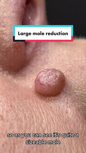 Advanced Mole Reduction Treatment with Electrolysis