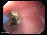 Alcoholic Cirrhosis - Coagulation of Site of the Bleeding by Use of Argon Plasma Coagulator • Video • MEDtube.net