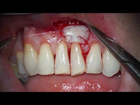 Suturing Free gingival graft