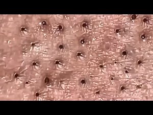 Blackheads & Whiteheads Satisfying Removal Acne and Pimple @0745