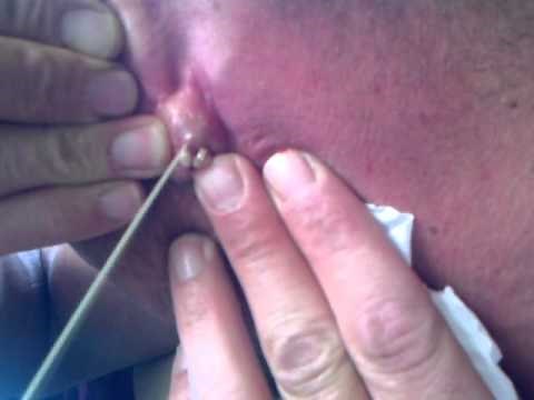 Exploding Cyst