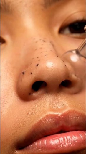 ASMR Nose Blackhead Extraction | Deep Pore Cleansing & Satisfying Suction Sounds 💧