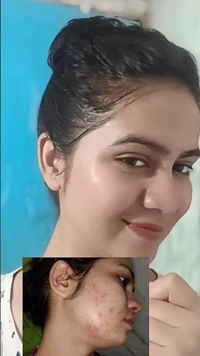 A simple way to apply Azelaic acid gel #aziderm #azelaicacid