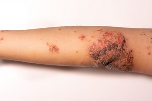How to Recognize and Treat Impetigo