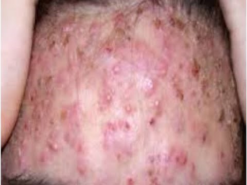 Pimple popping and blackheads removal (372)