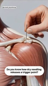 Dry needling is a great way to release muscle tension in seconds, needle a trigger points directly, or a motor point and it resets the muscle, releases stagnation, and get circulation flowing bringing qi and blood to the area. It’s not acupuncture, as acupuncture is focused on bringing harmony to the organs and balancing yin and yang, but it speaks the same language, using the nervous system to create change fast. Dry needling doesn’t add anything to the body. It simply reminds the tissue how to