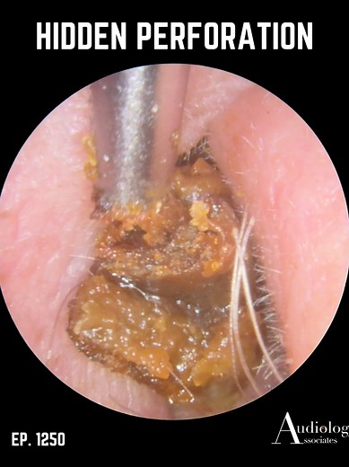 Hidden Mastoid Perforation & Ear Wax Removal EP1250
