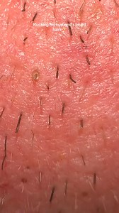 77Satify !! Pulling out my husbands beard pili multigemini hair #pick #plucking #asmr #beard #multigemini #sebaceousfilament #beardhairplucking #satisfyingvideos #extractions #ingrownhair | Helene Christensen