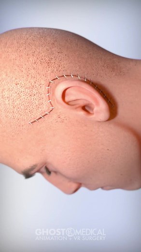 Surgical Treatment for Petroclival Meningioma: Baylor Scott & White Health's Transpetrosal Approach