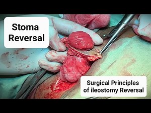 Stoma Reversal | Surgical principles of Ileostomy Reversal - Dr Tayyab Riaz Ch